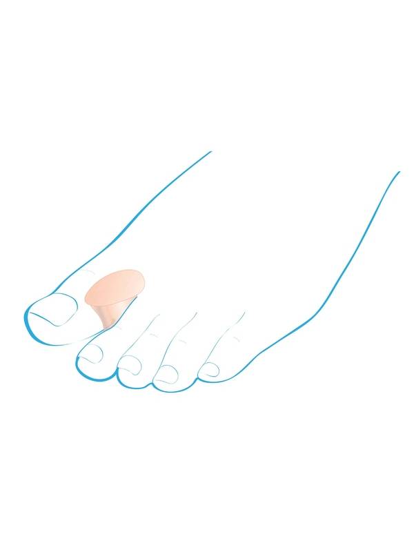 Межпальцевые ортопедические разделители - "Крейт" С-400